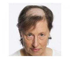 niechirurgiczne uzupełnianie włosów peruki dorothy , Dorota Olejniczak